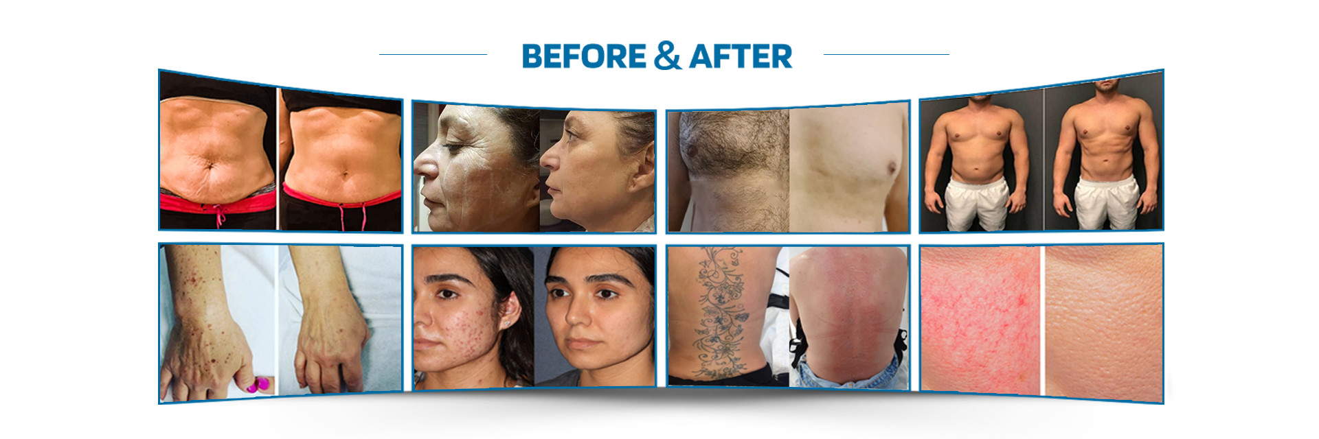 Kalite lazer epilasyon makinesi Fabrika