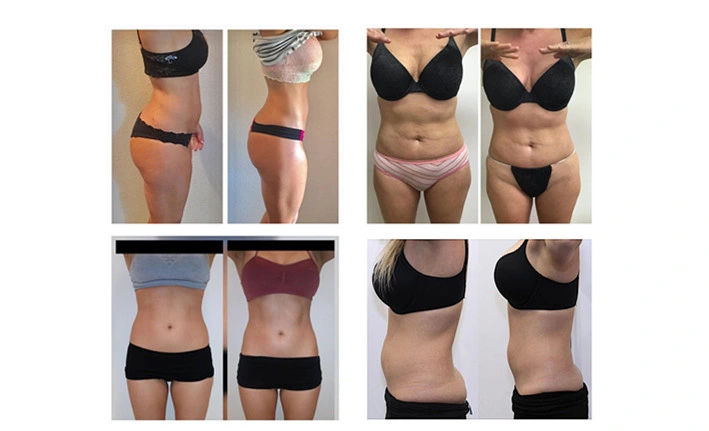 Gelişmiş 6 boyutlu lipolaser lipoliz 209mw Super 6d Lipo Lazer Liposuction Makinesi 635nm 650nm 780nm 810nm 940nm 980nm 6